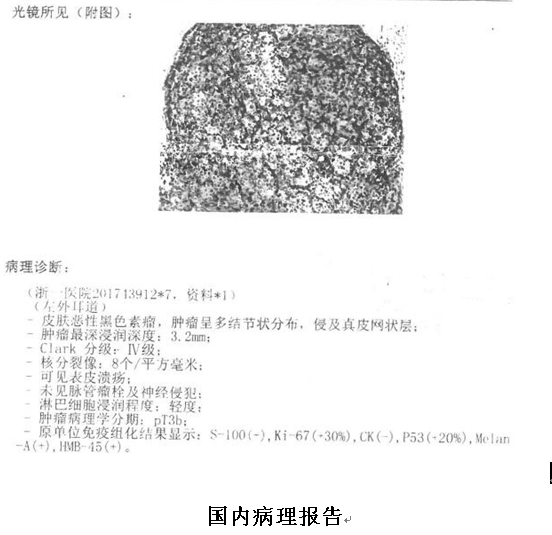 你还在用干扰素治疗黑色素瘤吗?