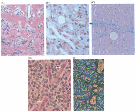 出国看病：恶性肿瘤来源于机体的非上皮组织