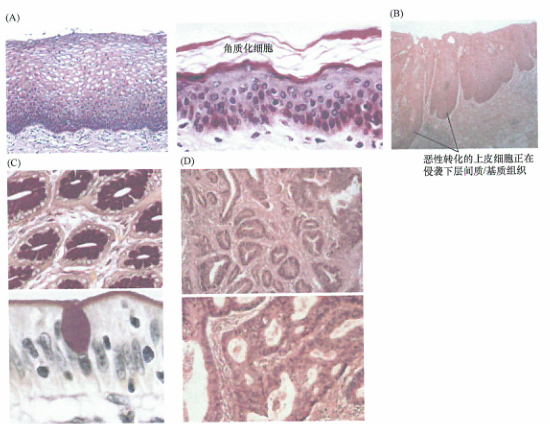 出国看病：各种癌症 常见腺癌的组织位置
