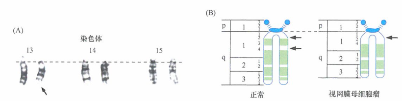 出国看病：对视网膜母细胞瘤细胞中染色体的研究