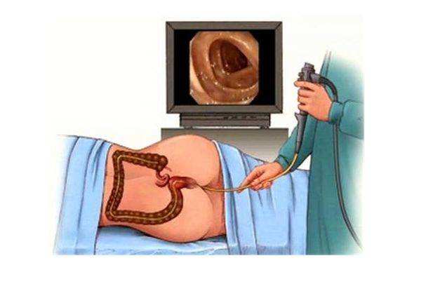 美国看病：结肠镜检查结果添加了新的证据