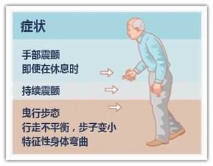 出国看病：帕金森症患者早期有哪些症状