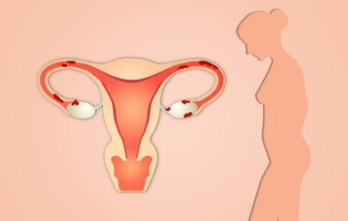 出国看病：卵巢切除不会增加心脏病风险