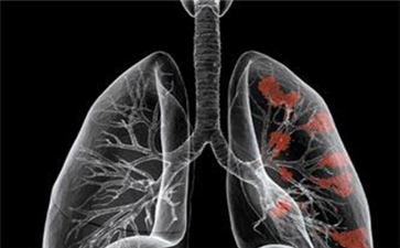 出国看病:什么是小细胞肺癌?