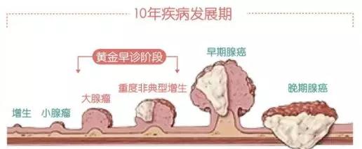 出国看病：美国结肠癌症生存率高达60%
