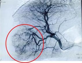 美国看病：乙型肝炎药物对抗肝纤维化，肝硬化作用比较