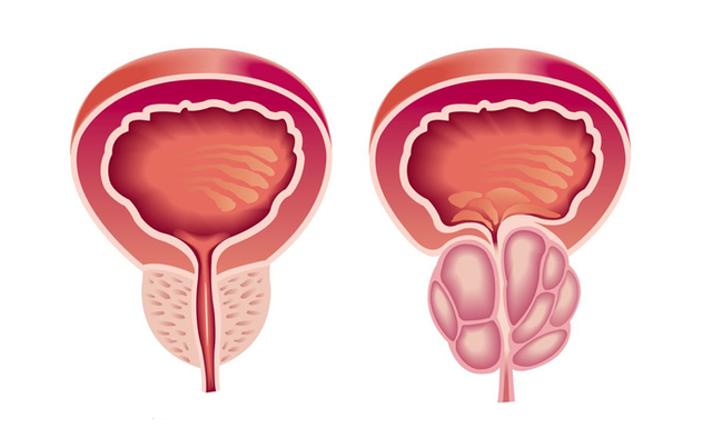 治疗前列腺癌不一定要放化疗