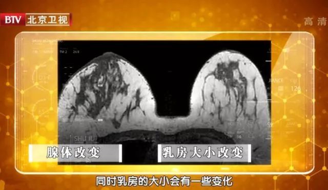 乳腺癌的症状，乳腺癌的自检和预防