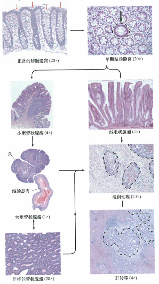 人类结肠癌组织的病理学形态改变