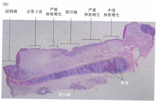 结肠中肿瘤发展的实际情况