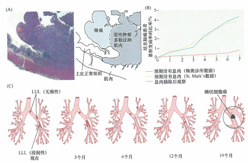 人类的结肠癌都是由已经存在的腺瘤发展而来的