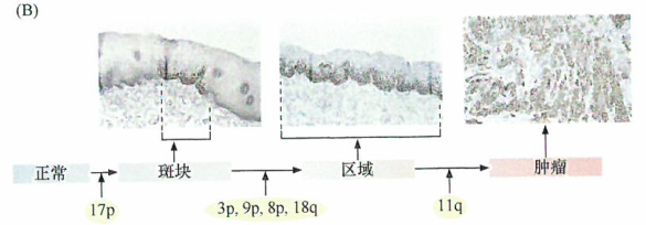 食物导致肿瘤进展速率的过程加快