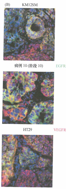 在肿瘤细胞进展至完全恶性状态的过程中，可能会发生大量的基因变异事件