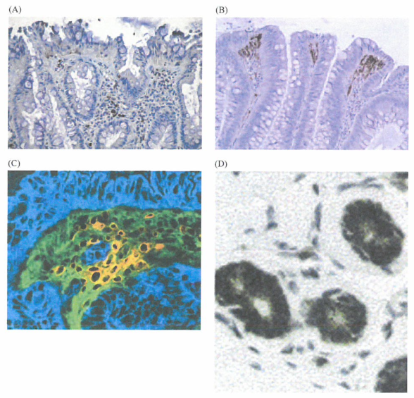 肿瘤C0X-2的表达和它的PGE2T游产物的作用
