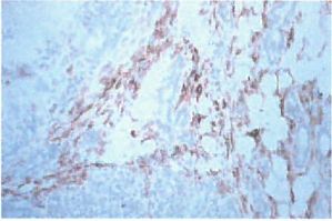 巨噬细胞和骨髓细胞在活化肿瘤相关间质过程中起重要作用