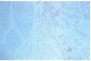 肿瘤细胞释放的集落刺激因子​
