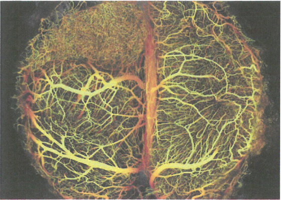 肿瘤相关微血管的异常组织形态