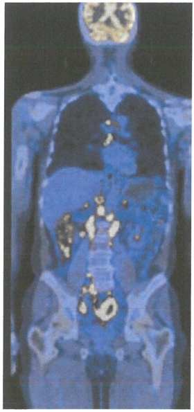 肿瘤转移的主要困惑之一是不同肿瘤发生转移的能力不同