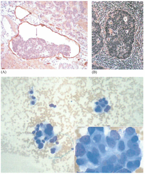 侵袭转移是肿瘤发病机制研究中主要悬而未决的问题