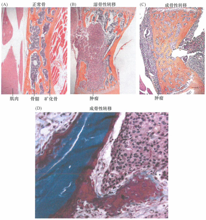 大部分类型的转移癌细胞本身并不能重塑骨骼结构