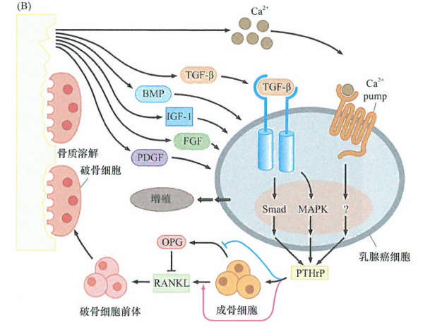 地诺单抗在延缓转移性乳腺癌患者发生重度骨相关并发症方面更有效