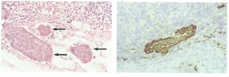 淋巴道在癌细胞播散中的作用不很明显