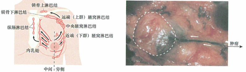 原发瘤的引流淋巴结在肿瘤分期方面也具有应用价值