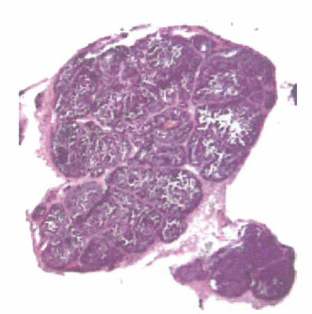 基底膜是癌细胞侵袭过程中首先遇到的障碍