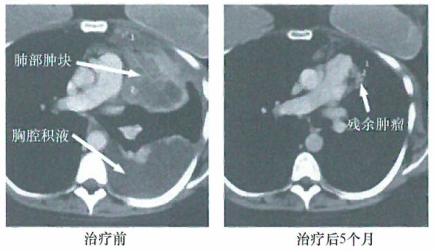 通过抗CTLA-4抗体抑制CTLA-4的肿瘤免疫治疗的策略研究