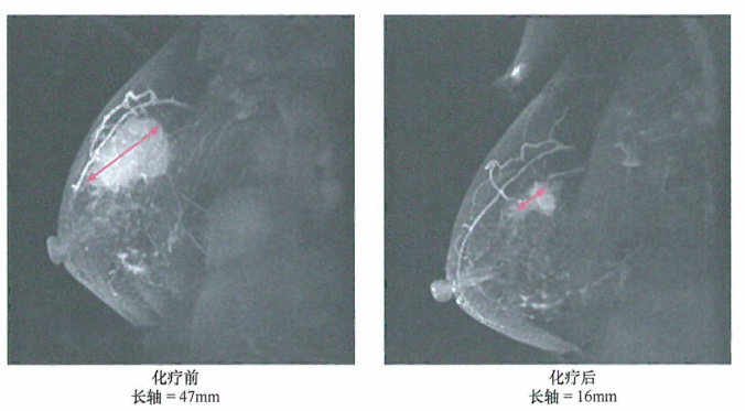 美国乳腺癌发病率与死亡率对比研究