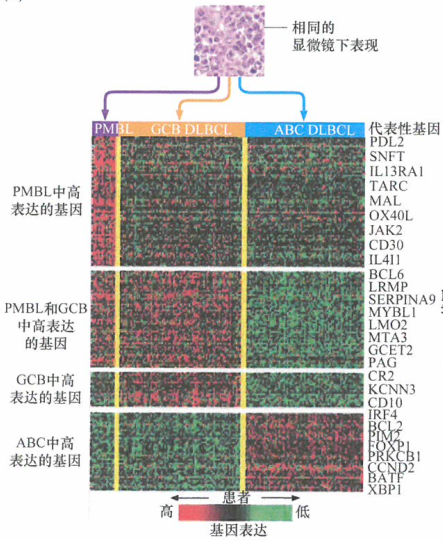 弥散性大B细胞淋巴瘤的亚类分层