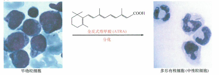 维甲酸和诱导肿瘤细胞的分化研究