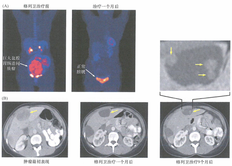 使用格列卫治疗胃肠道间质瘤研究