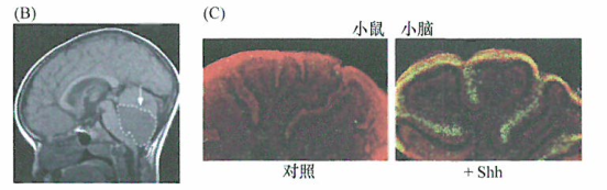 癌细胞Patched-Smoothened信号通路的干预研究