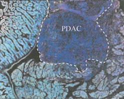 肿瘤治疗现状与展望的研究