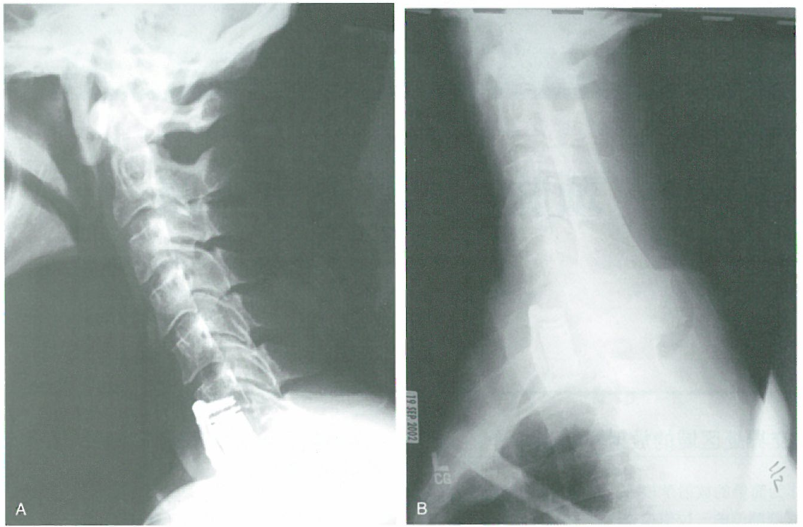 颈胸交界处区域的放射学影像研究
