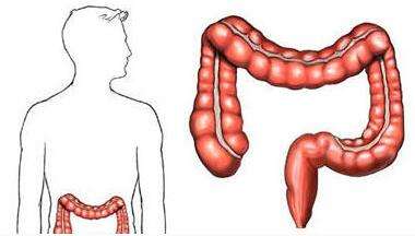 采用IRA的患者发生直肠癌的风险研究