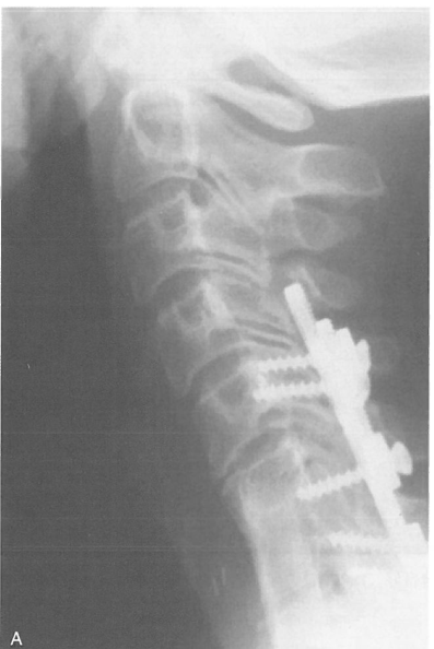 颈胸交界处区域的放射学影像研究