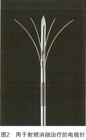 治疗结直肠癌肝转移的消融技术研究