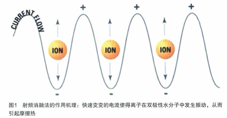 治疗结直肠癌肝转移的消融技术研究