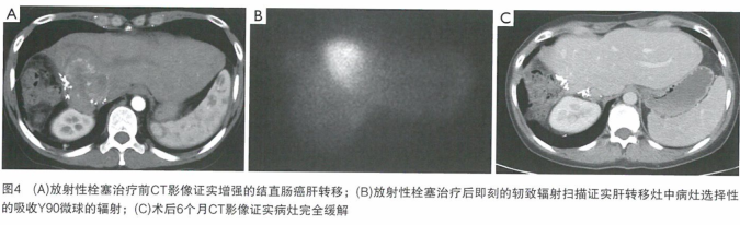 结直肠癌肝转移的化疗栓塞疗法研究