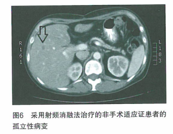 联合治疗转移性结肠癌的综合案例研究