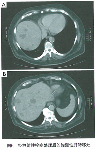 联合治疗转移性结肠癌的综合案例研究
