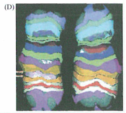 染色体片段拷贝数的增加和减少的研究
