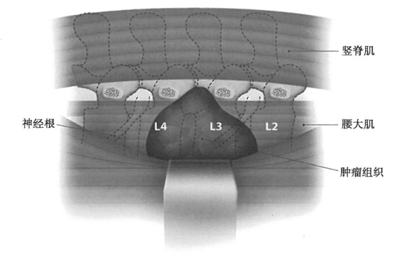 脊柱肿瘤L3水平推旁​巨大肿瘤案例研究