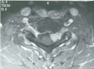 累及椎间孔的颈椎神经鞘瘤研究