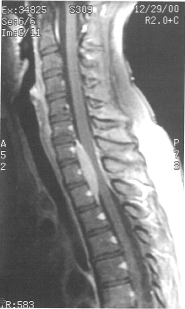 脊膜瘤的外科治疗研究