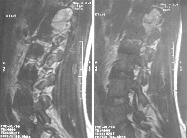 L1推体的哑钤型舯瘤病例研究