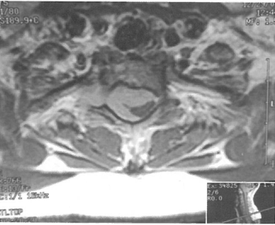 脊膜瘤的外科治疗研究