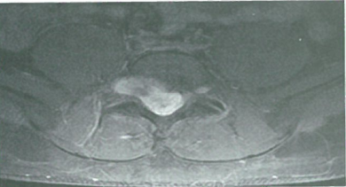 髓外肿瘤的类型及外科治疗研究